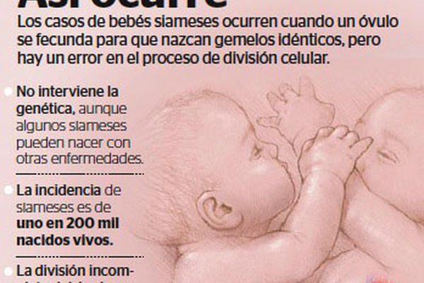 Infografía como nacen bebés siameses.
