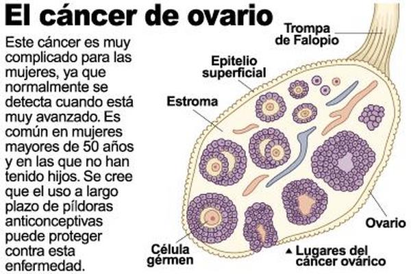 Las mujeres mayores de 50 años tienen mayor riesgo de padecer cáncer de ovarios