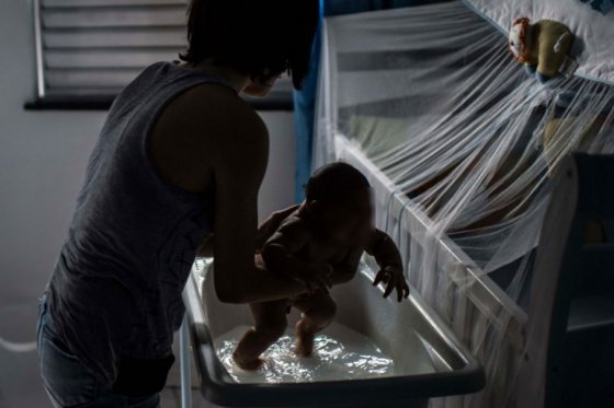 Zika, microcefalia. (Foto Prensa Libre: AFP)