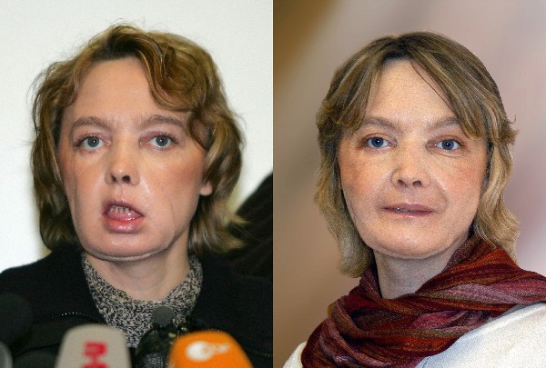Isabelle Dinoire recibió el primer trasplante de rostro en el mundo. (Foto Prensa Libre: AFP).