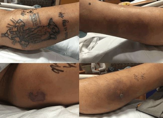 La infección del tatuaje comenzó un día después de haber nadado en el mar. (Foto Prensa Libre: Independent UK)