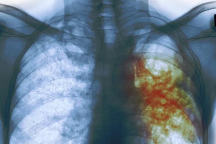 Radiografía de una persona con tuberculosis. (Foto Prensa Libre: Hemeroteca PL)