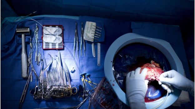 El riñón donado al único paciente que sigue con vida le tuvo que ser extraído. (GETTY IMAGES)