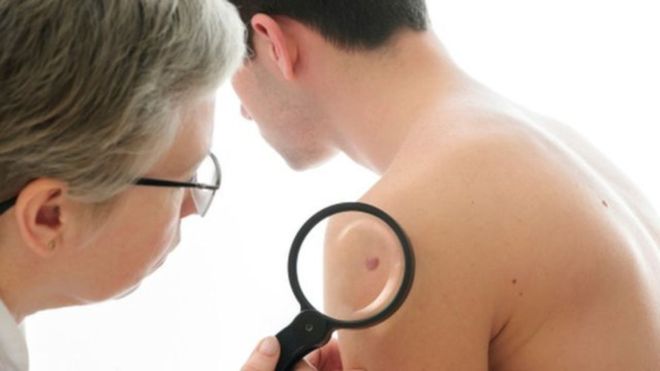 La autoexploración es fundamental para una detección temprana del cáncer de piel. (Foto Prensa Libre:GETTY IMAGES)