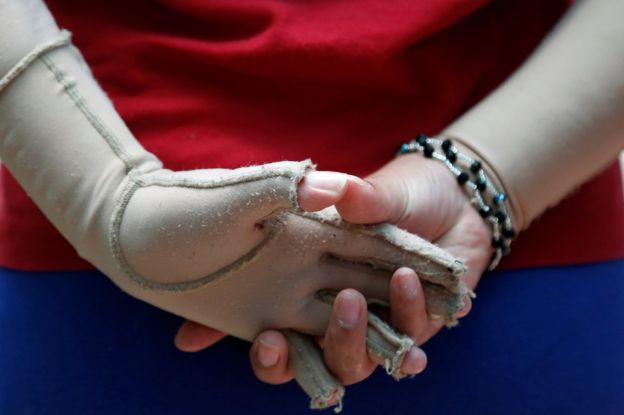 En el incendio resultaron gravemente heridas 15 niñas, quienes sufrieron amputaciones y se ven obligadas a usar prótesis varias. REUTERS