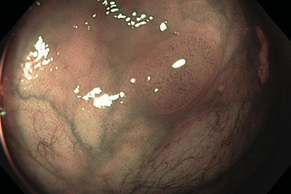 Adenoma canceroso detectado con la nueva tecnología de colonoscopía. (Foto Prensa Libre: Archivo)