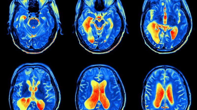 La pérdida de líquido cefalorraquídeo afecta a cinco de cada 100.000 personas al año. (iStock).