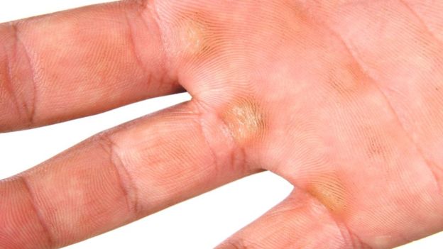 Los callos son un mecanismo de defensa. (Getty)