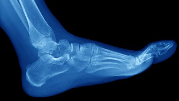 Las fracturas por estrés suelen ocurrir en los huesos de la parte inferior de la pierna y el pie, como la tibia y el peroné, los metatarsos, el talón y el tobillo. GETTY IMAGES