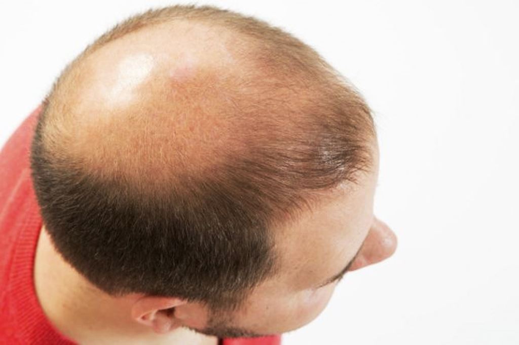 No hay cura para la calvicie, pero al menos ahora saben qué la produce. (THINKSTOCK)