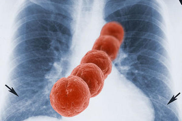 Analizan la división celular del neumococo para desarrollar nuevas vacunas. <br _mce_bogus="1"/>