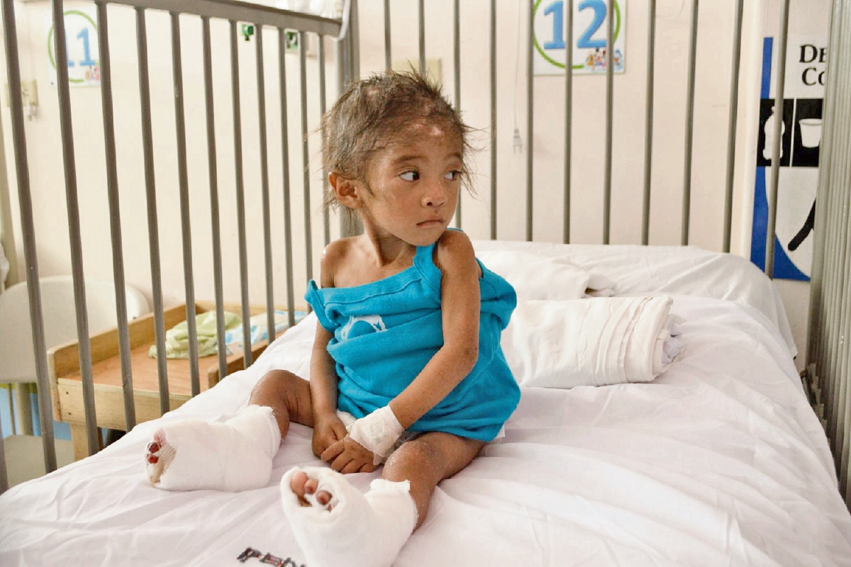 Blanca Estela  Lorenzo, de 3 años,   se recupera en el Hospital Regional de Cuilapa.