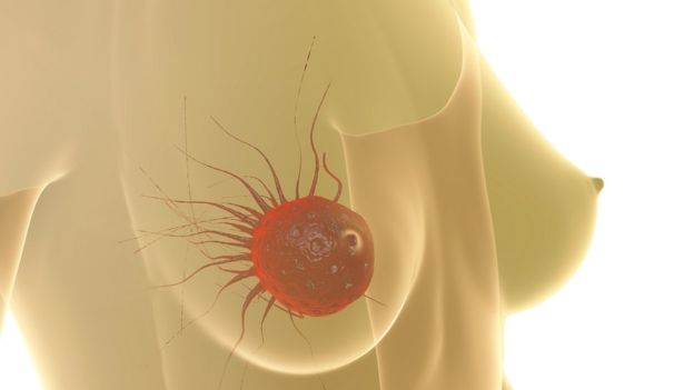 Una de las razones de su alta mortalidad es que suele ser diagnosticado en las fases más avanzadas. XRENDER