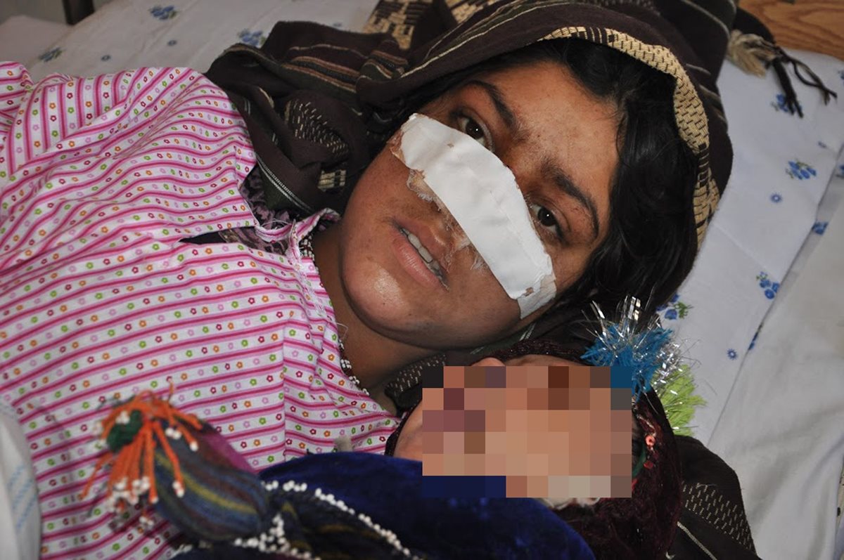 Mujer afgana cuyo esposo le cortó la nariz pide ayuda para operarse