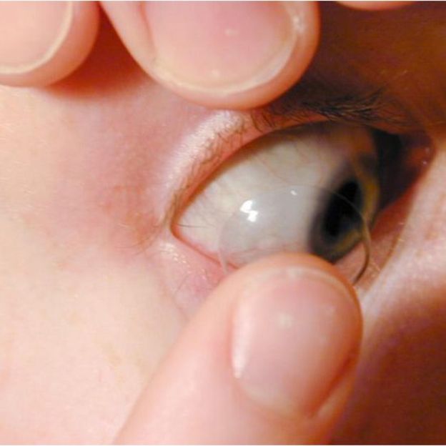 Aunque la pérdida de lentes de contacto suele ser común, los médicos no daban crédito a lo que encontraron.