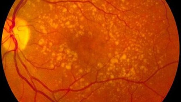 Las pestañas LED también aumentan el riesgo de degeneración macular y el deterioro de la retina. WIKI COMMONS