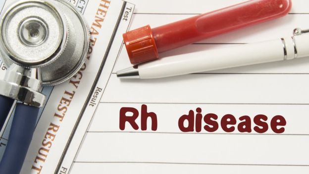 La enfermedad hemolítica del recién nacido es un trastorno en el que la madre durante el embarazo produce anticuerpos en la sangre que destruyen los glóbulos rojos del feto. GETTY IMAGES