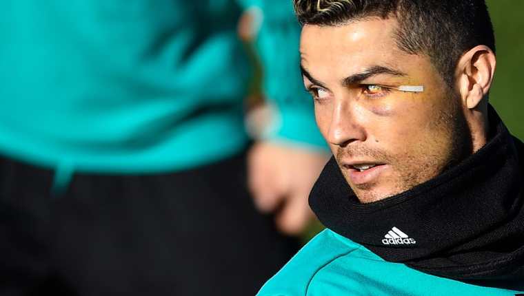 Cristiano Ronaldo sigue en recuperación luego de la lesión que sufrió en el ojo izquierdo la semana pasada. (Foto Prensa Libre: EFE)