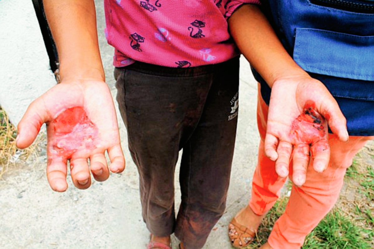Los niños presentan lesiones en distintas partes del cuerpo. (Foto Prensa Libre: Rolando Miranda)