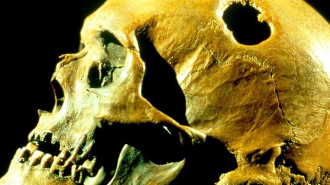 Hay evidencia de que se practicó la trepanación en diversas culturas, hasta por lo menos la Edad Media. Pero las razones no están claras. SCIENCE PHOTO LIBRARY