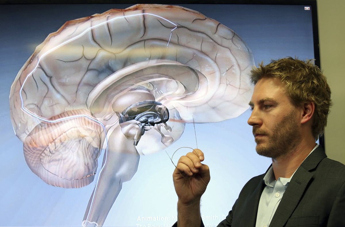 El doctor Nicholas Opie muestra un electrodo llamado "estentrodo" en el Royal Melbourne Hospital en Melbourne, que ayudará a pacientes a volver a caminar. (Foto Prensa Libre, EFE)