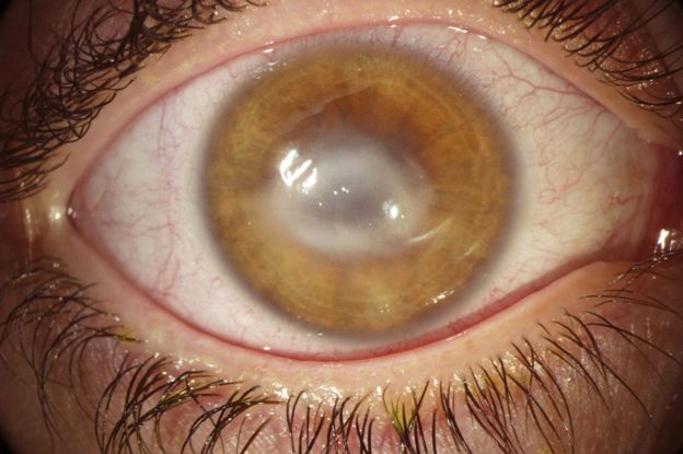 La queratitis por Acanthamoeba puede dañar la córnea del ojo y nublar la visión. SCIENCE PHOTO LIBRARY