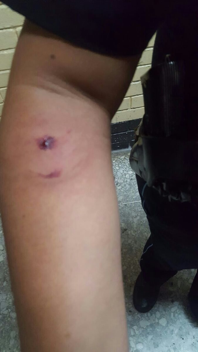 Agente del OJ agredida, muestra herida causada por mujer que era trasladada a Torre de Tribunales. (Foto Prensa Libre: Carlos Hernández)