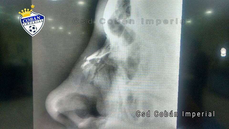 La radiografía muestra la lesión en la nariz del jugador de Cobán Imperial. (Foto Prensa Libre: Cobán Imperial)