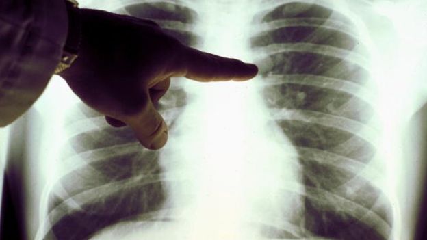 El síndrome provoca distintos tumores malignos en diferentes partes del cuerpo. GETTY IMAGES