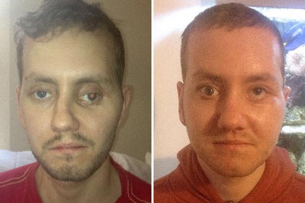 Se utilizó para la cirugía de Stephen Power, de 29 años, quien sufrió un accidente en el 2012 y cuyo rostro quedó desfigurado, como se observa en las otras fotos.