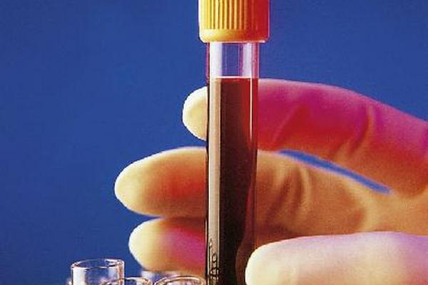 Prueba de sangre puede descubrir si una persona sana está predispuesta a sufrir infarto.