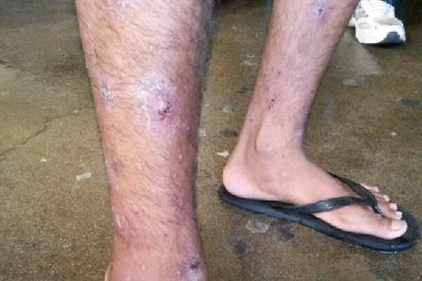interno de la cárcel de Jalapa muestra la afección que padece en la piel.