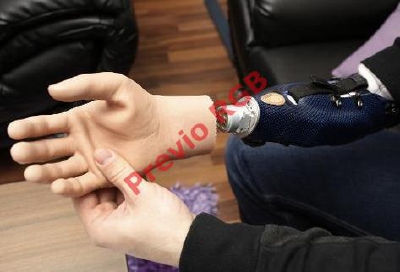 El paciente  austríaco Milorad Marinkovic muestra su mano biónica.
