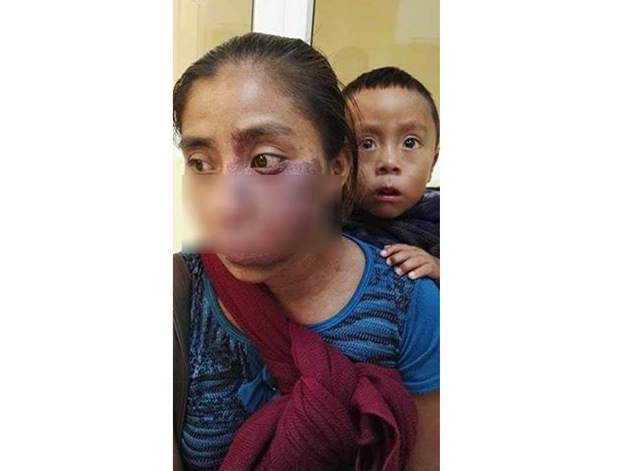 Glenda Marisela Cruz Sales reside en Huehuetenango, y necesita un costoso tratamiento por un tumor en el rostro. (Foto Prensa Libre: Facebook)