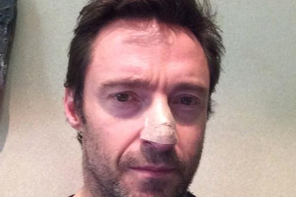 Hugh Jackman fue operado de un cáncer de piel que tenía en la nariz. <br _mce_bogus="1"/>