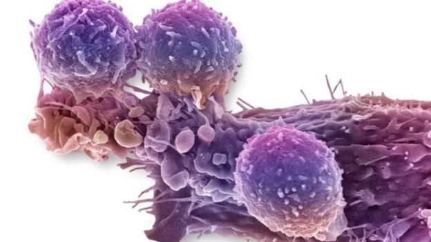 La terapia involucra insertar un gen en las células T del paciente para que éstas reconozcan y ataquen las células cancerosas. SPL