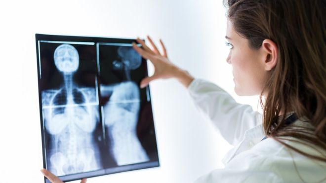 El cáncer inflamatorio de mama es el más raro de este tipo de carcinomas. ILBUSCA