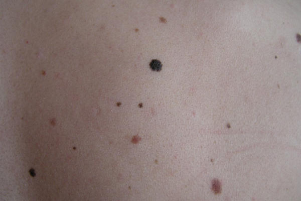 Los tumores benignos de piel son señales de alarma para otros males.