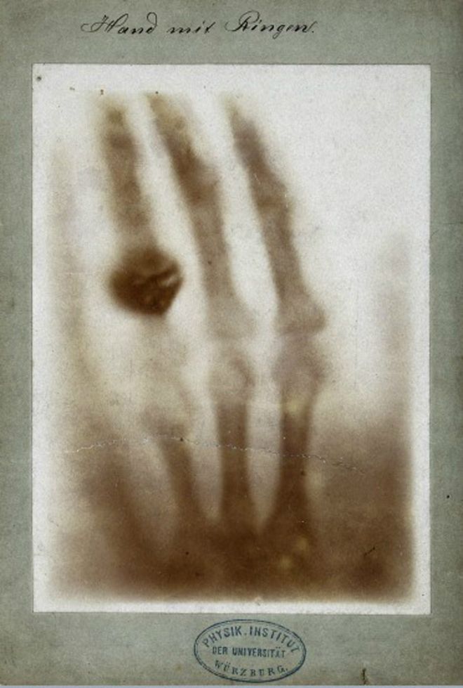 La primera imagen de rayos X provocó inquietud pues parecía una intromisión en la intimidad de la gente. Imagen cortesía del Welcome Trust. WELCOME TRUST