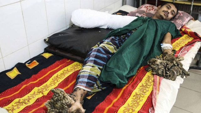 El hombre árbol ha sido sometido a una serie de operaciones. (Foto Prensa Libre: EFE)