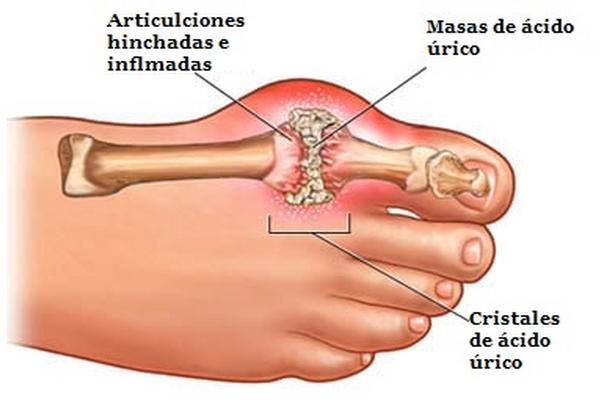 El exceso de ácido úrico afecta las articulaciones