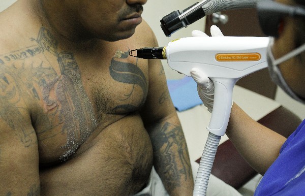 Un beneficiario del programa de remoción de tatuajes del Gobierno de El Salvador. (Foto Prensa Libre: EFE)