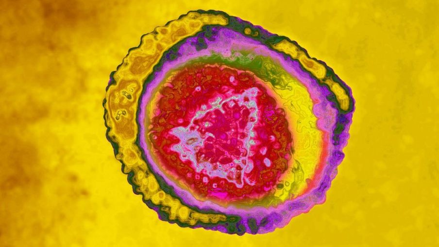 El virus del herpes humano tiene ocho cepas. La 1 causa herpes labial, pero también puede ser encontrada en los genitales; la 2 causa herpes genital, la 3, varicela y herpes zoster; la 4 (o EBV), mononucleosis infecciosa y linfoma de Burkitts; la 5 o citomegalovirus causa el síndrome de la mononucleosis; la 6 y la 7, roséola y la 8 causa sarcoma de Karposis y linfoma. (Getty Images/BSIP).