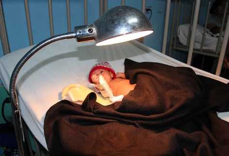 Niño con  desnutrición es atendido en el Hospital Nacional de Jalapa.