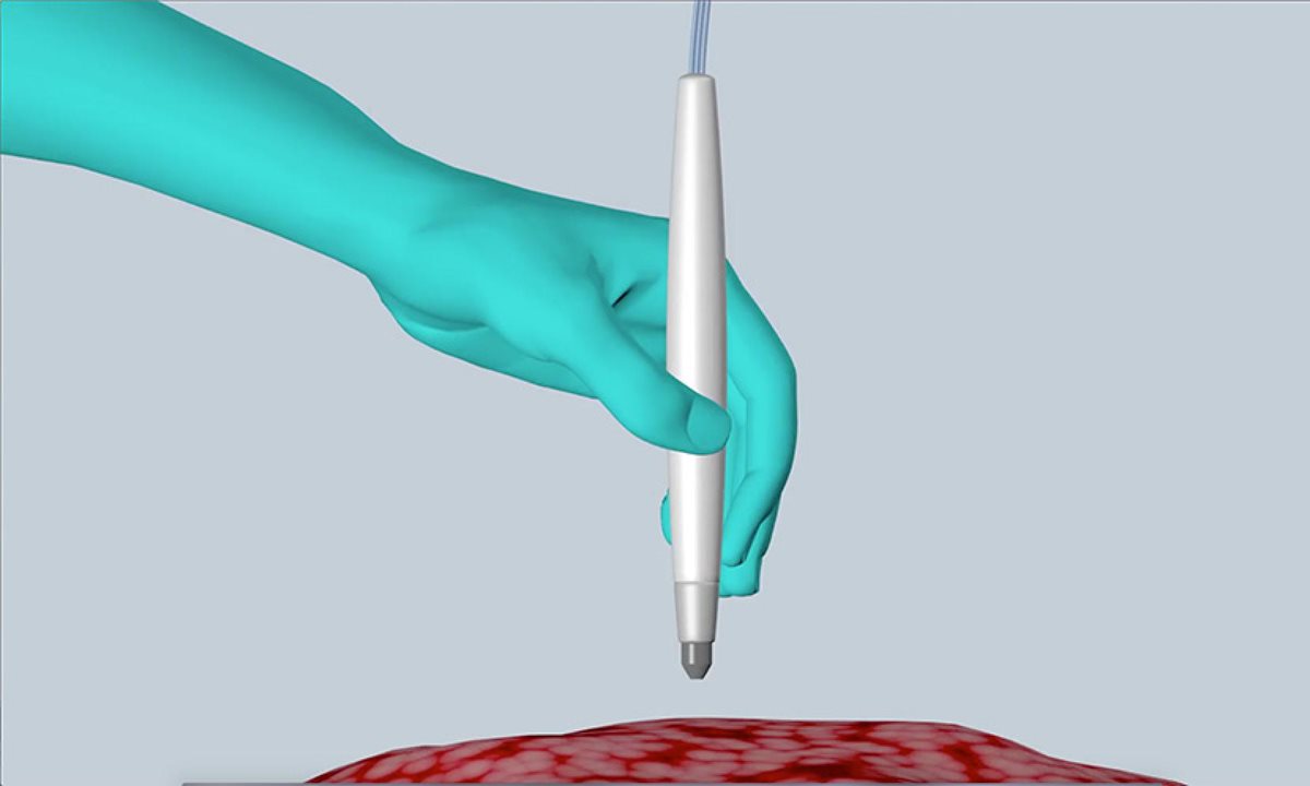 El dispositivo será utilizado durante cirugías, con el objetivo de mejorar los tratamiento y reducir las recaídas (Foto Prensa Libre: UT).