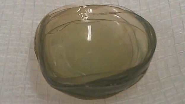 Un cuerpo extraño resultó ser una masa de 17 lentes contactos "pegados como mocos". (BMJ).