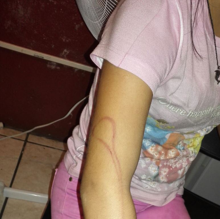 La menor muestra las señales de violencia que le causó su madre con el cable de un cargador de celular. (Foto Prensa Libre: Rolando Miranda)