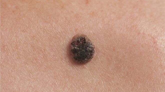 El síntoma más común del melanoma es la aparición de un nuevo lunar o la presencia de cambios en uno ya existente. THINKSTOCK