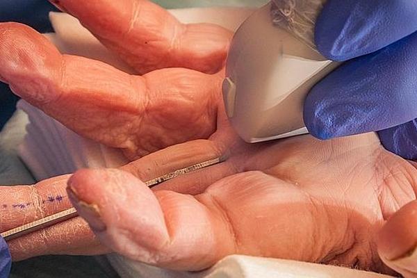 La cirugía ecoguiada es mínimamente invasiva y no necesita del bisturí