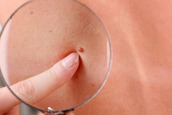 El dolor y picor son señal de cáncer de piel